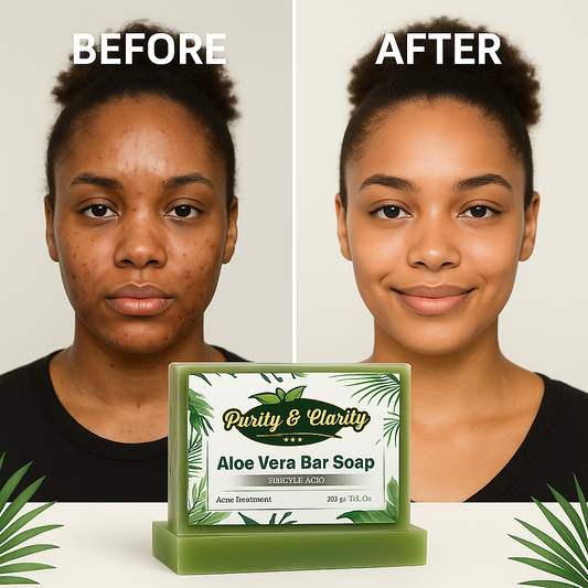 Aloe Vera Bar Soap Acne-Fighting & Soothing Care– 200g - Purity & Clarity, LLC