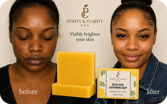 Kojic Acid Lightening Face & Body Bar Soap – 200g